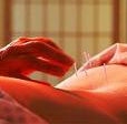 acupuncture